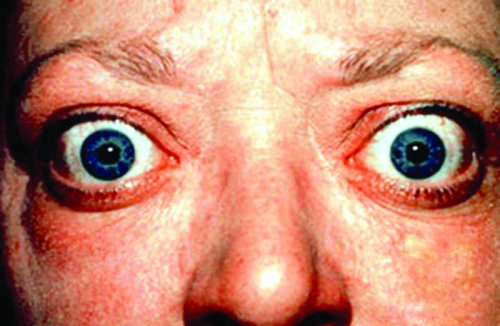 Endocrine disorders: Exophthalmos